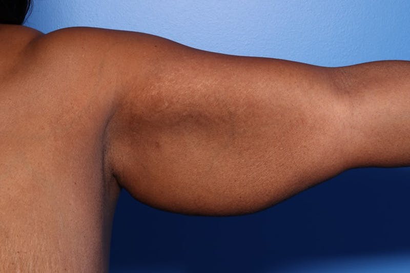 Arm Lift Before & After Gallery - Patient 330658 - Image 3