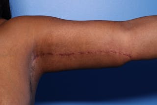 Arm Lift Before & After Gallery - Patient 330658 - Image 4
