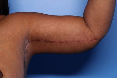Arm Lift Before & After Gallery - Patient 330658 - Image 2