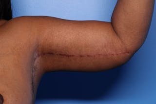 Arm Lift Before & After Gallery - Patient 330658 - Image 2
