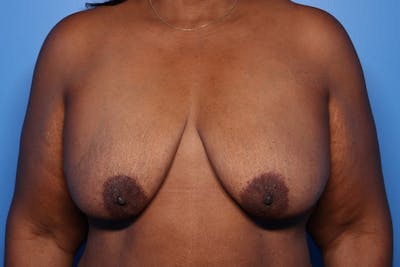 Body Lift Before & After Gallery - Patient 105647 - Image 1