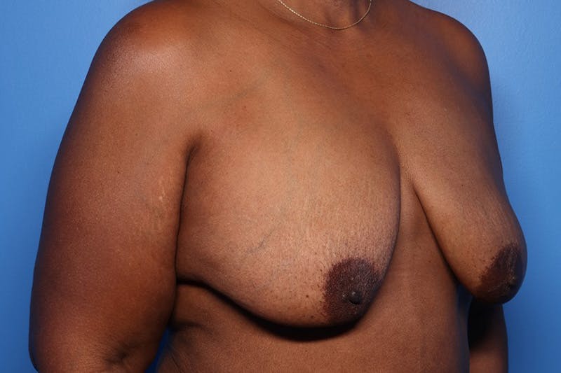 Breast Augmentation + Lift Before & After Gallery - Patient 396288 - Image 3
