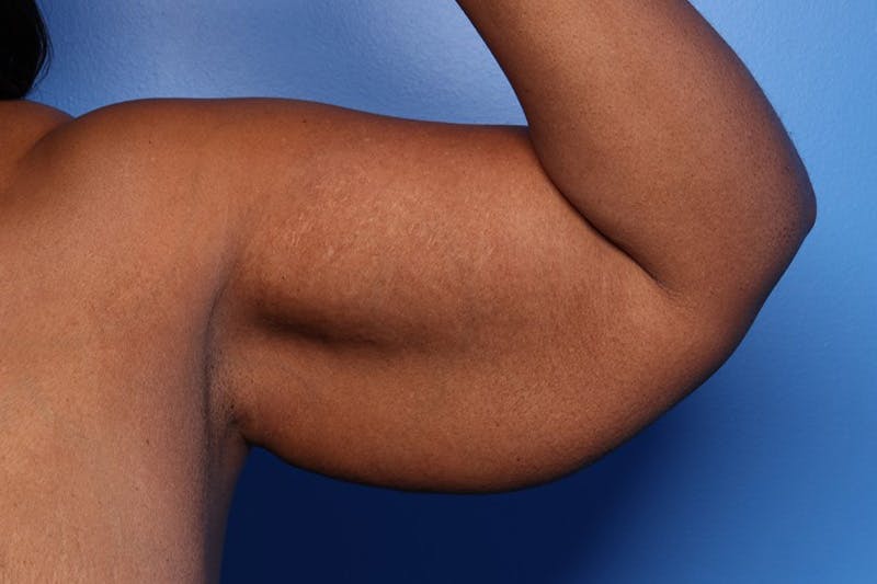 Arm Lift Before & After Gallery - Patient 330658 - Image 1