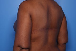 Body Lift Before & After Gallery - Patient 105647 - Image 8