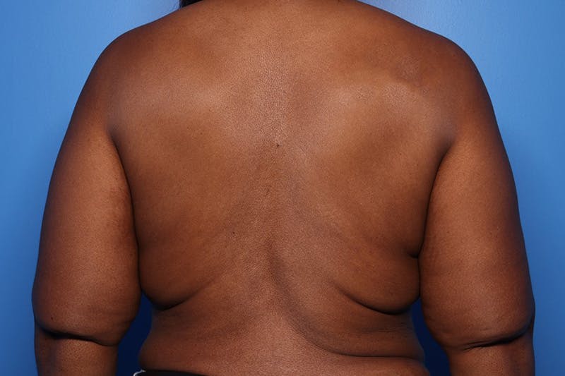 Breast Augmentation + Lift Before & After Gallery - Patient 396288 - Image 9