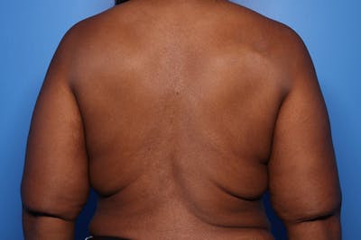 Bra Line Lift Before & After Gallery - Patient 126635 - Image 1