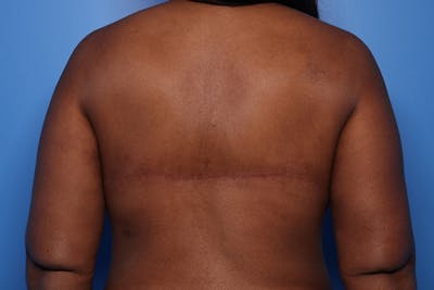 Bra Line Lift Before & After Gallery - Patient 126635 - Image 2