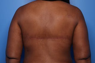 Body Lift Before & After Gallery - Patient 105647 - Image 10