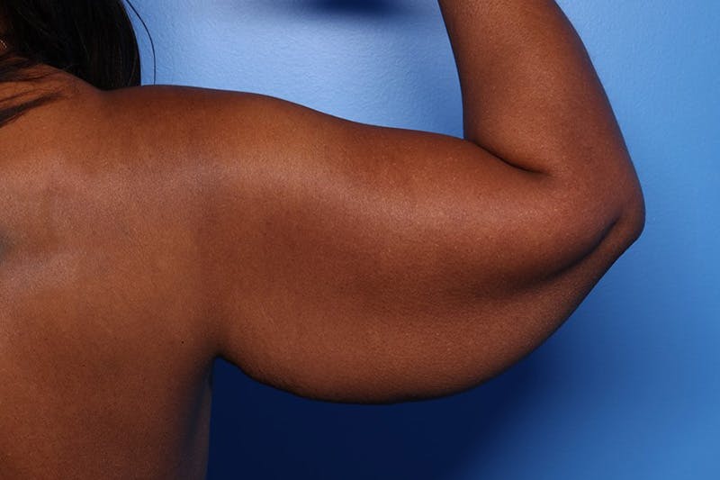 Arm Lift Before & After Gallery - Patient 330658 - Image 5