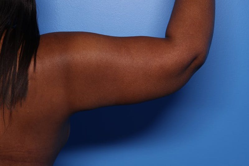Arm Lift Before & After Gallery - Patient 330658 - Image 6