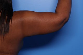 Arm Lift Before & After Gallery - Patient 330658 - Image 6