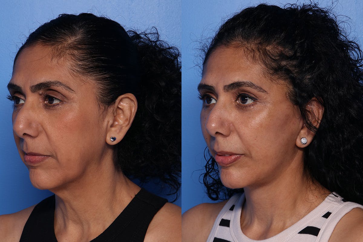 Fat Grafting Before & After Gallery - Patient 884403 - Image 5