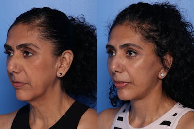Neck Lift Before & After Gallery - Patient 289211 - Image 1