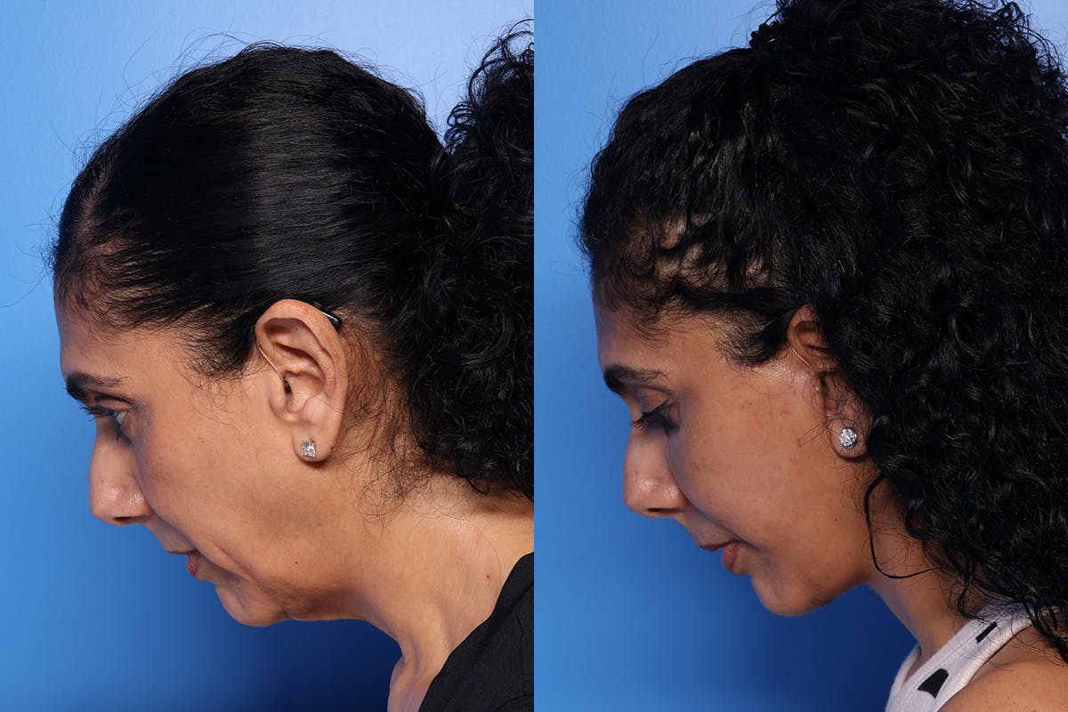 Fat Grafting Before & After Gallery - Patient 884403 - Image 7