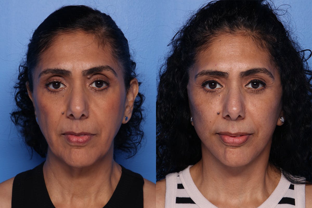 Fat Grafting Before & After Gallery - Patient 884403 - Image 1