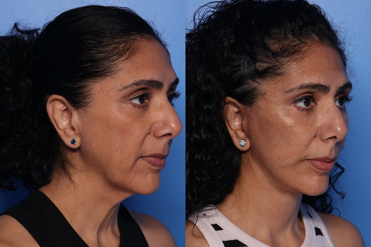 Fat Grafting Before & After Gallery - Patient 884403 - Image 2