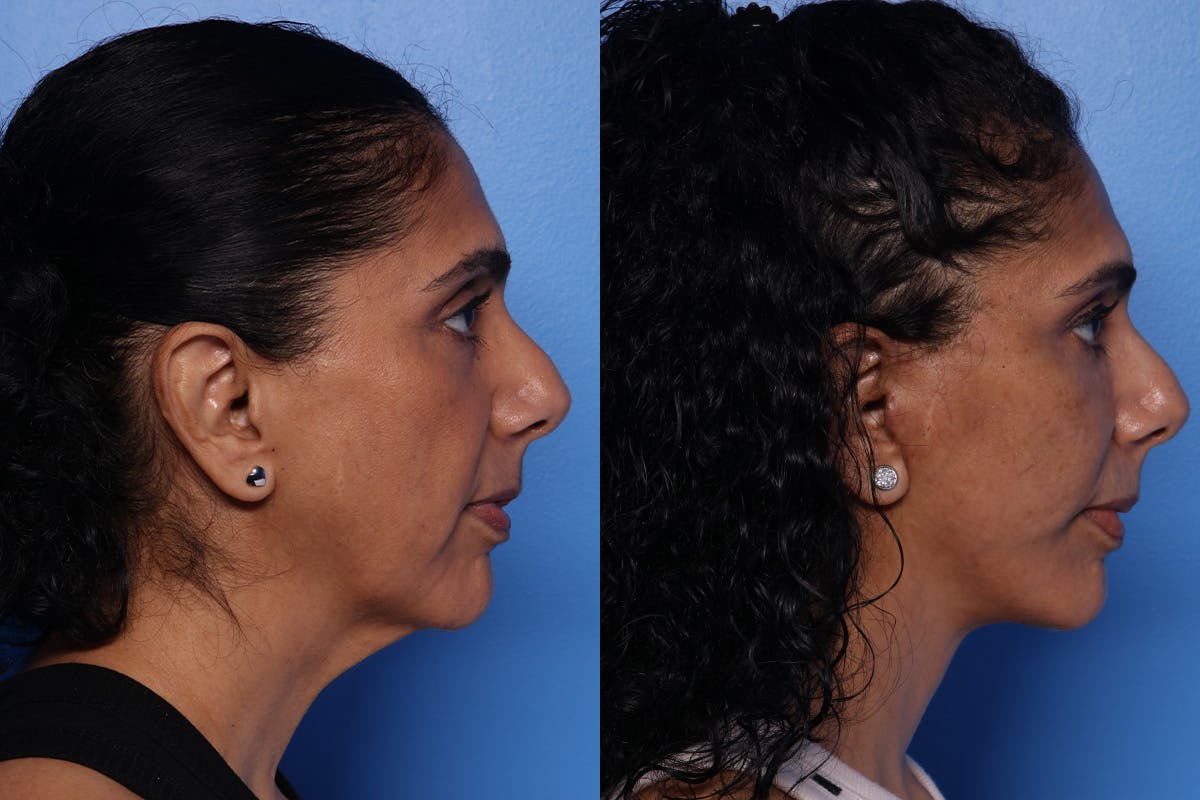Fat Grafting Before & After Gallery - Patient 884403 - Image 3