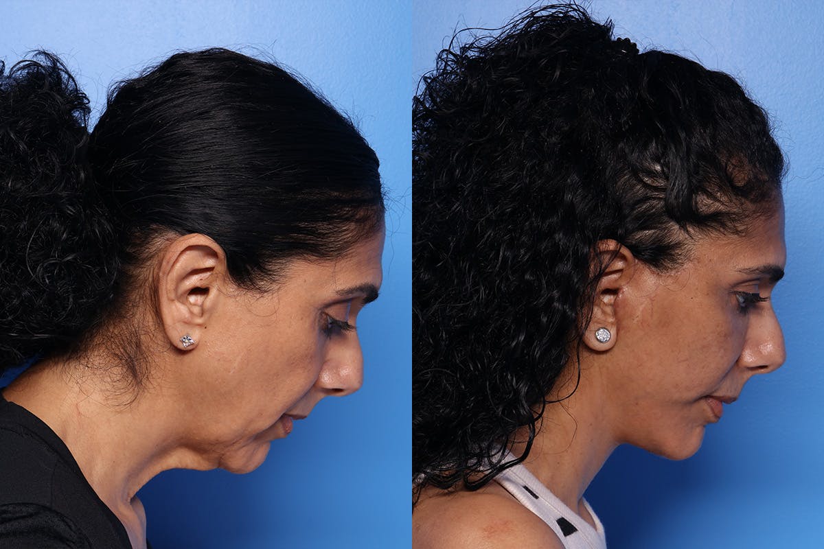Fat Grafting Before & After Gallery - Patient 884403 - Image 4