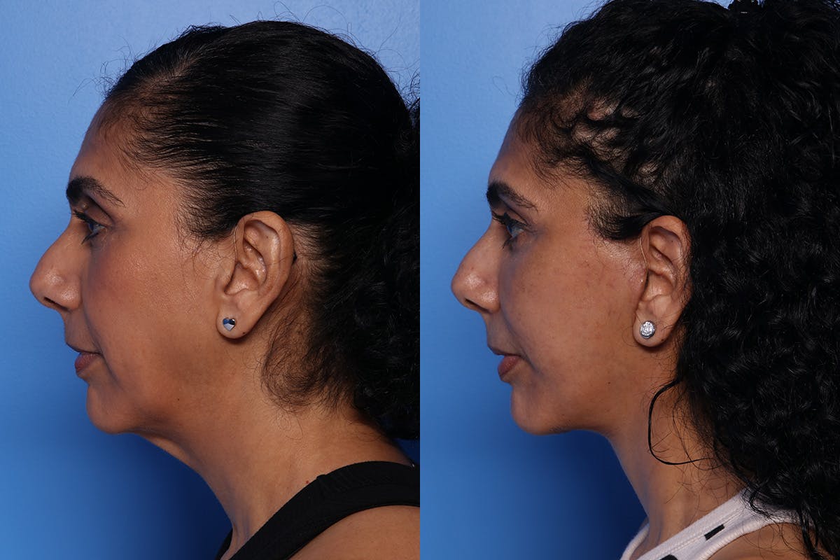 Fat Grafting Before & After Gallery - Patient 884403 - Image 6