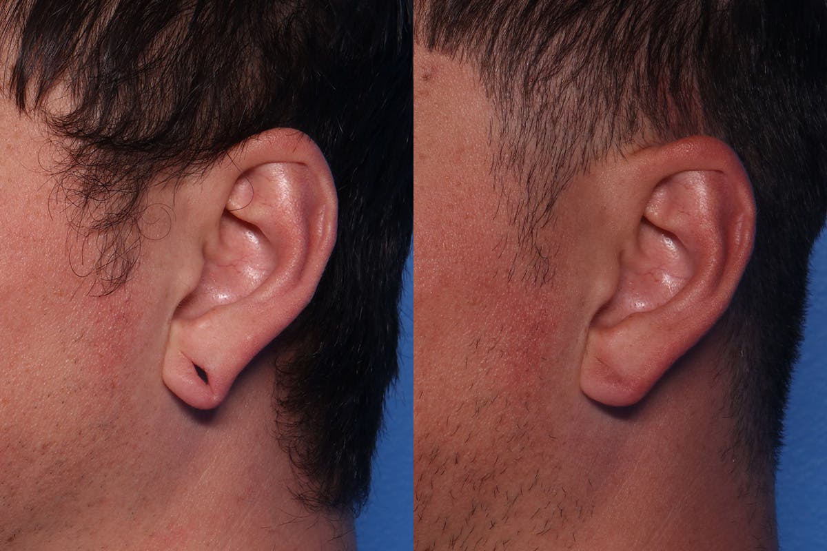 Earlobe Repair Before & After Gallery - Patient 171779 - Image 2