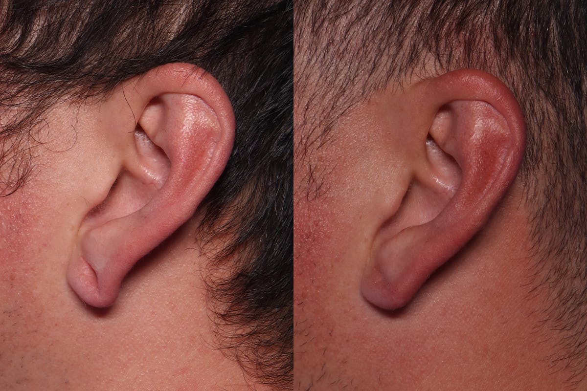Earlobe Repair Before & After Gallery - Patient 171779 - Image 1