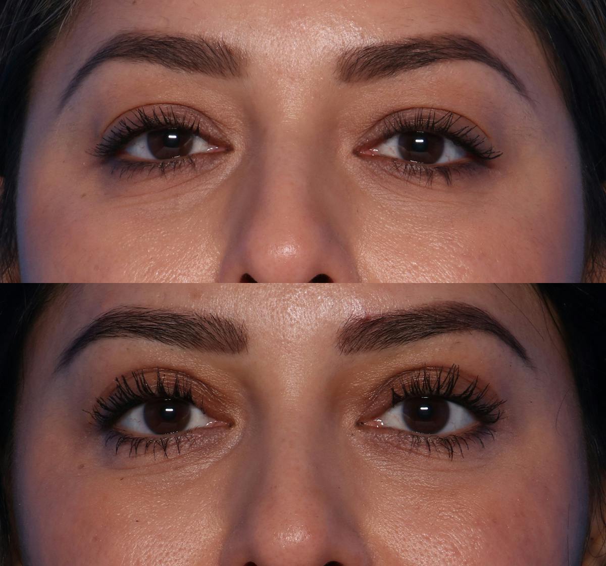 Blepharoplasty Before & After Gallery - Patient 149749 - Image 1
