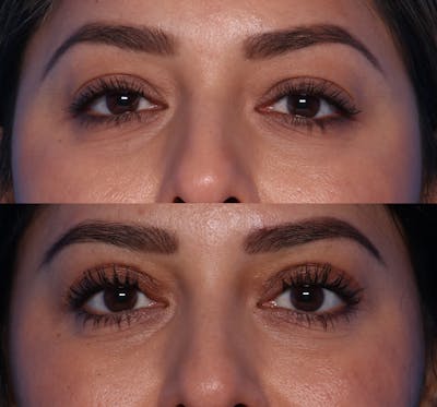 Blepharoplasty Before & After Gallery - Patient 149749 - Image 1