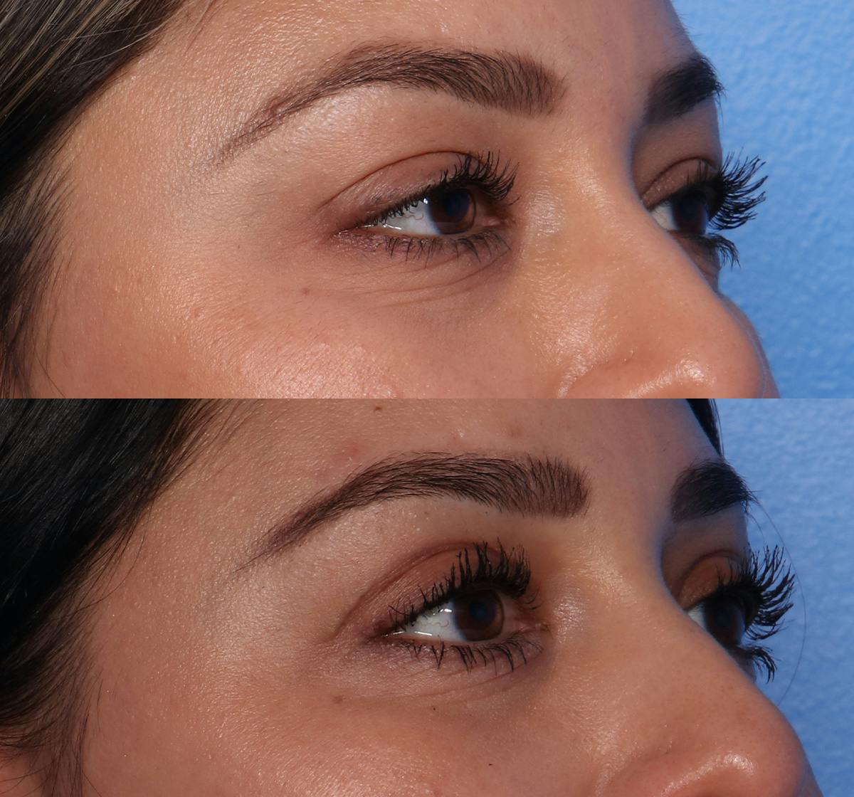 Blepharoplasty Before & After Gallery - Patient 149749 - Image 2