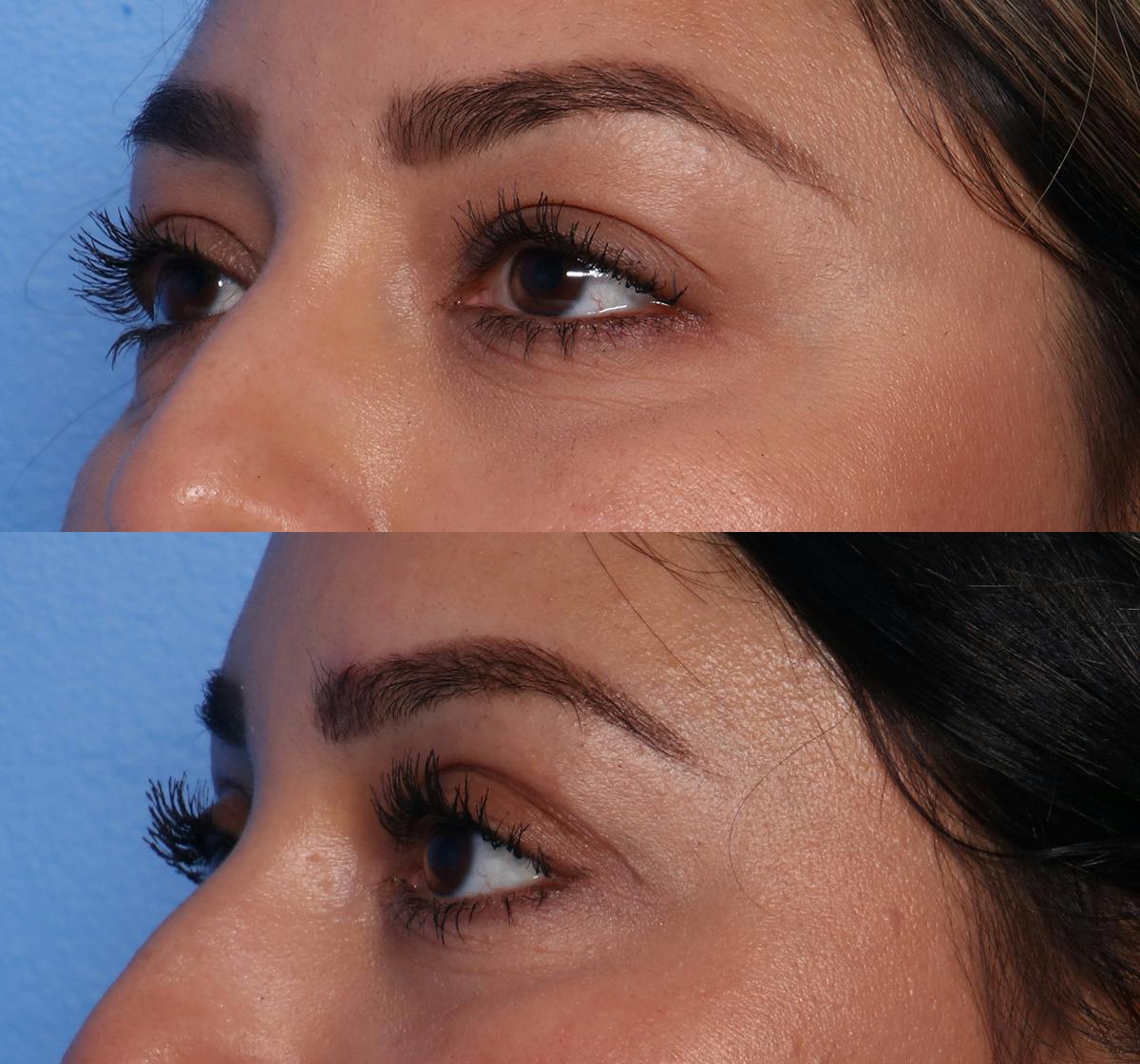 Blepharoplasty Before & After Gallery - Patient 149749 - Image 3