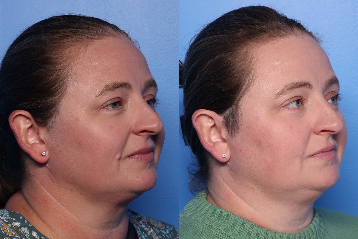 Mole Removal Before & After Gallery - Patient 384923 - Image 2