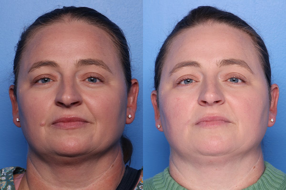 Mole Removal Before & After Gallery - Patient 384923 - Image 1