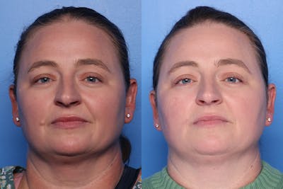 Mole Removal Before & After Gallery - Patient 384923 - Image 1