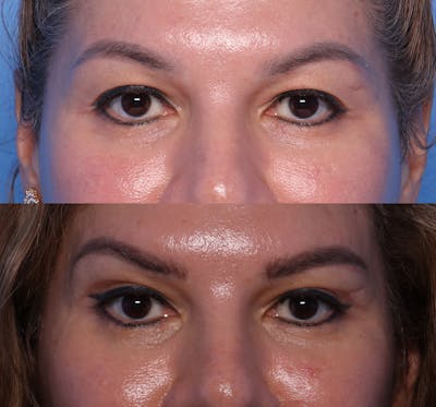 Blepharoplasty Before & After Gallery - Patient 488254 - Image 1