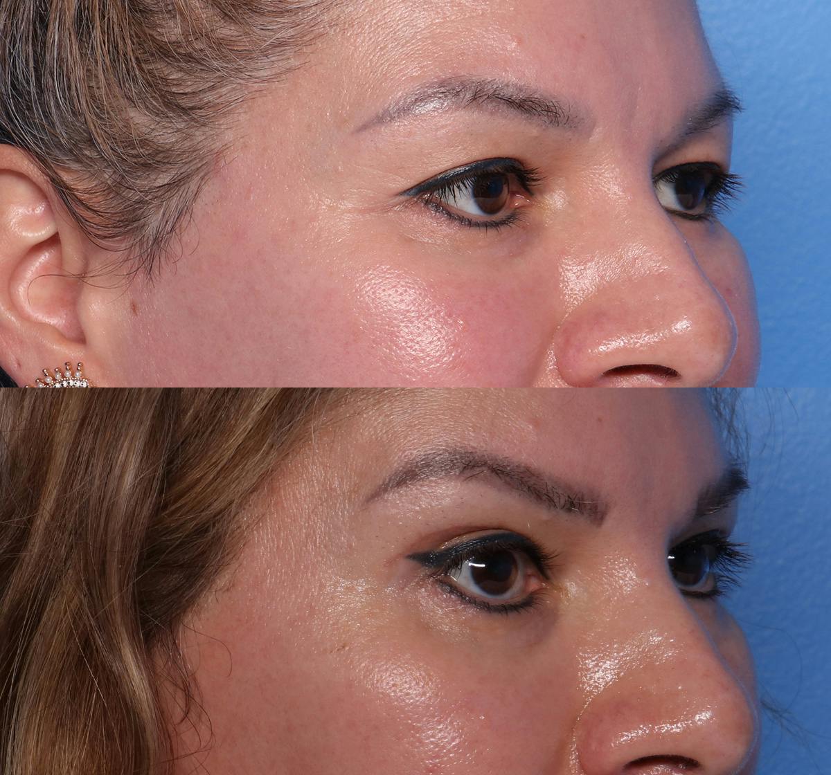 Blepharoplasty Before & After Gallery - Patient 488254 - Image 2