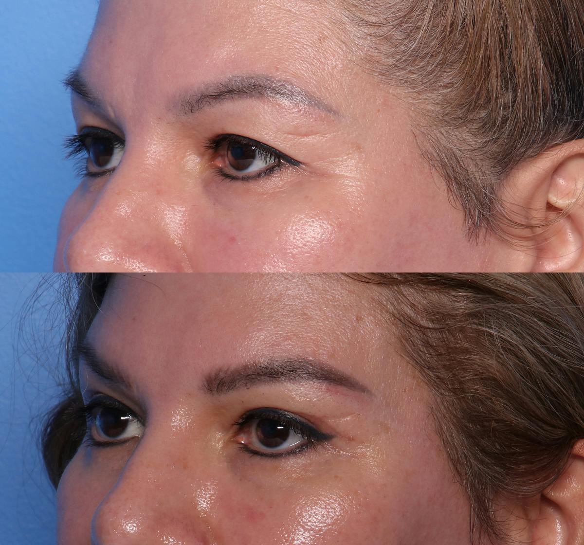 Blepharoplasty Before & After Gallery - Patient 488254 - Image 3