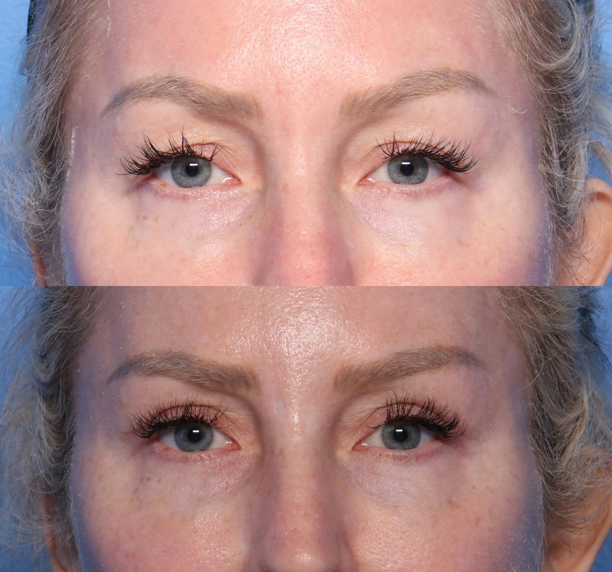 Blepharoplasty Before & After Gallery - Patient 291492 - Image 1