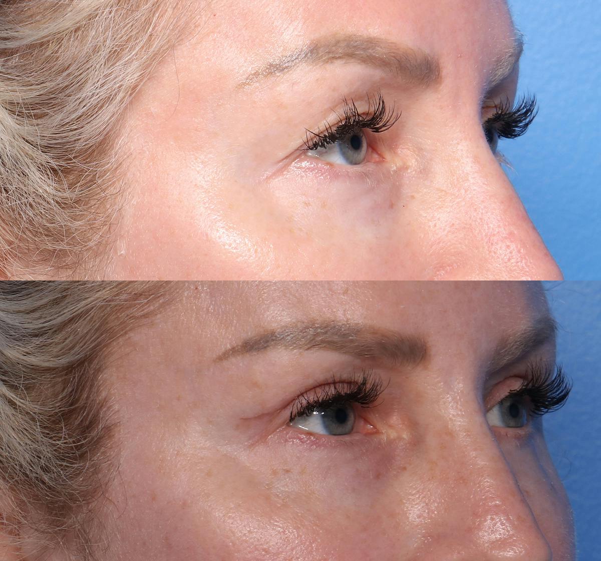 Blepharoplasty Before & After Gallery - Patient 291492 - Image 2