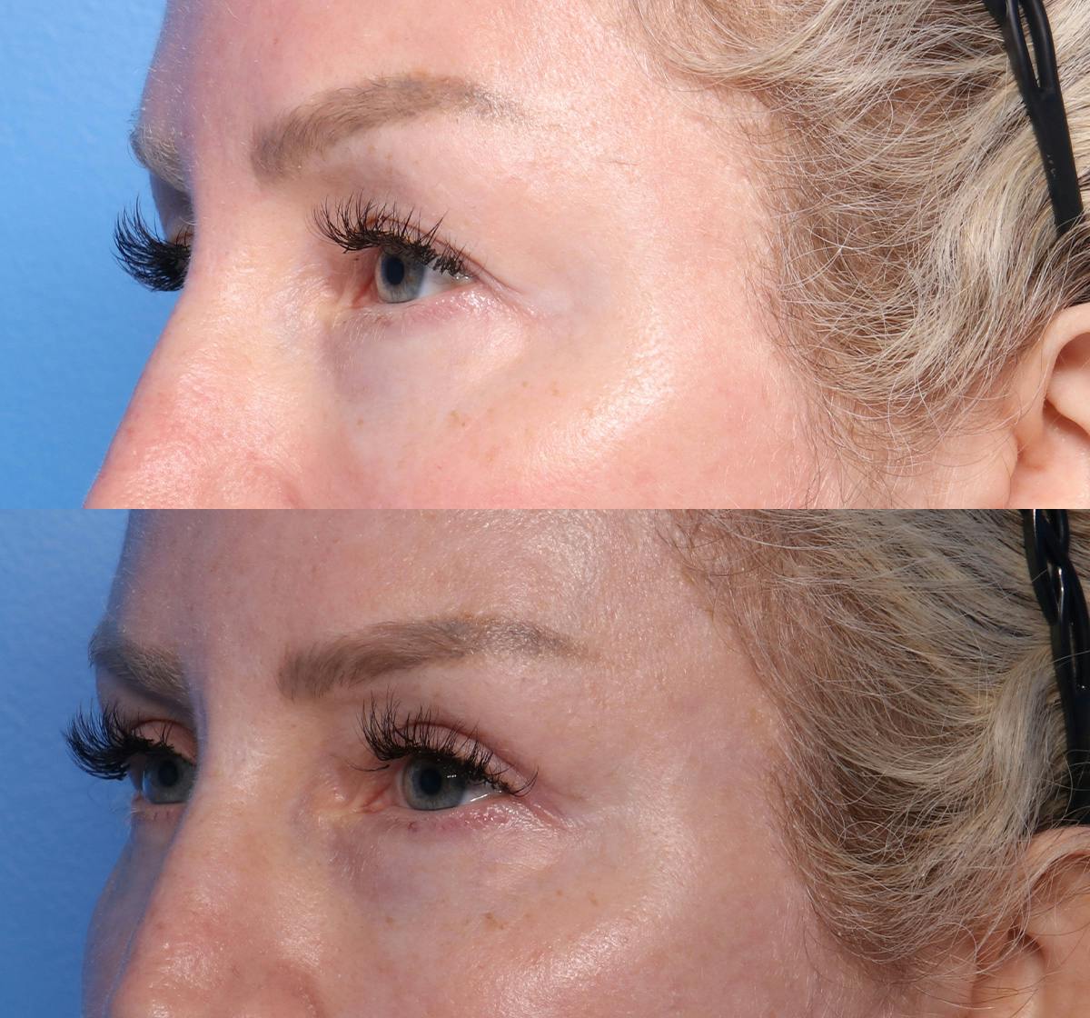 Blepharoplasty Before & After Gallery - Patient 291492 - Image 3