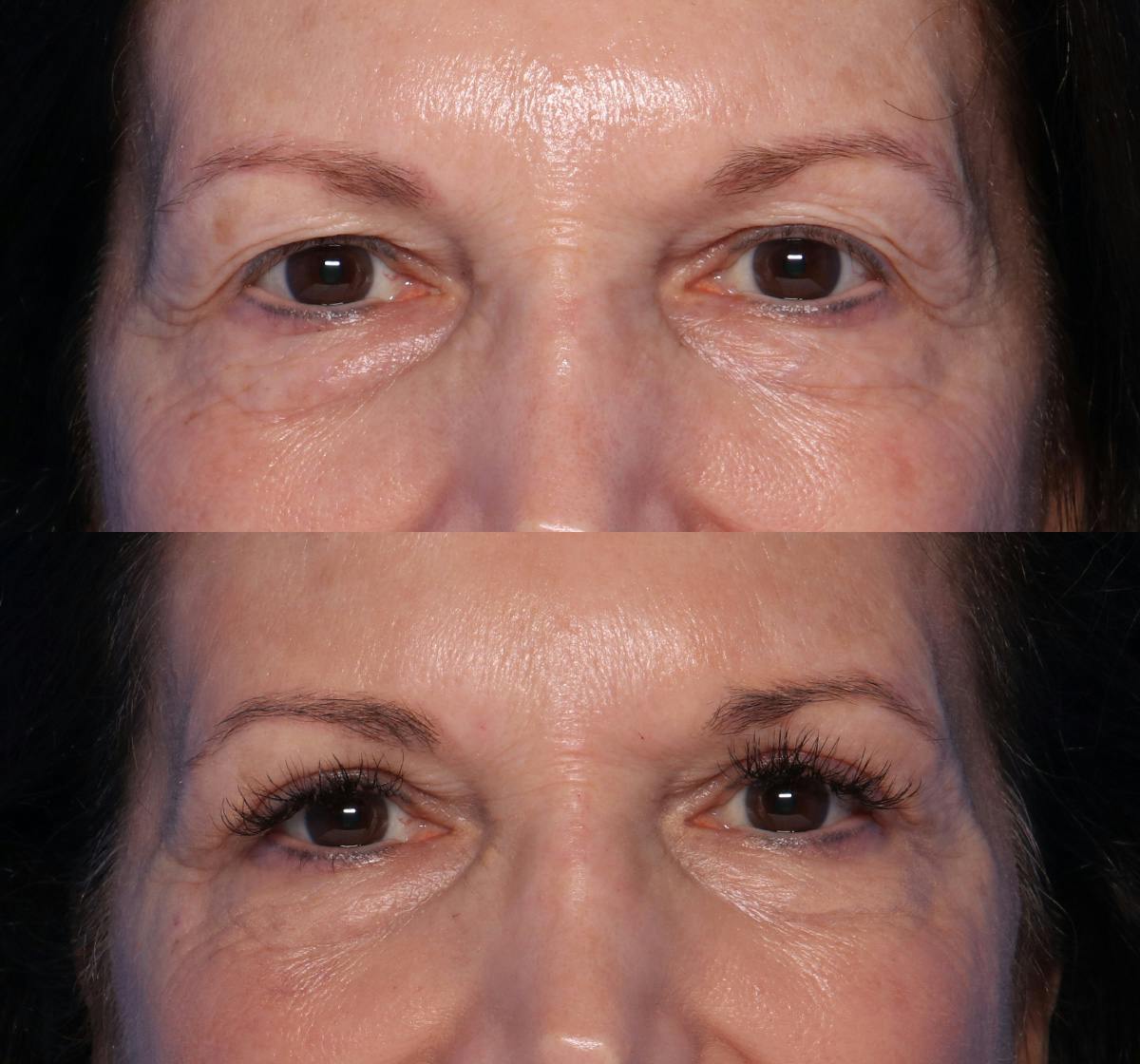 Blepharoplasty Before & After Gallery - Patient 203540 - Image 1