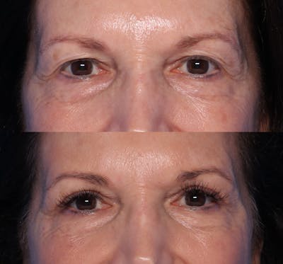 Blepharoplasty Before & After Gallery - Patient 203540 - Image 1