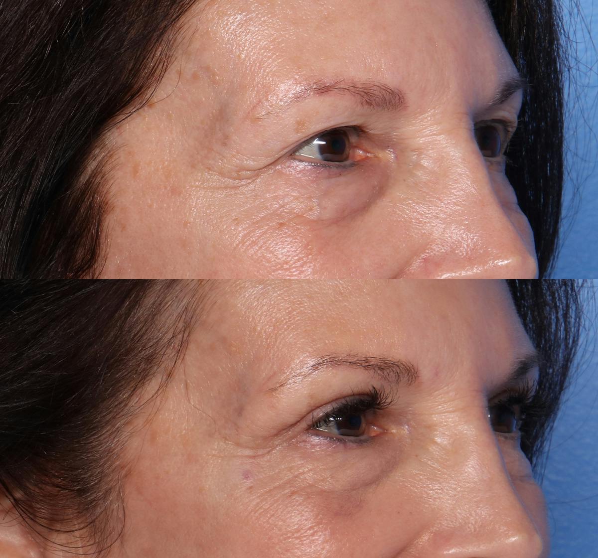 Blepharoplasty Before & After Gallery - Patient 203540 - Image 2