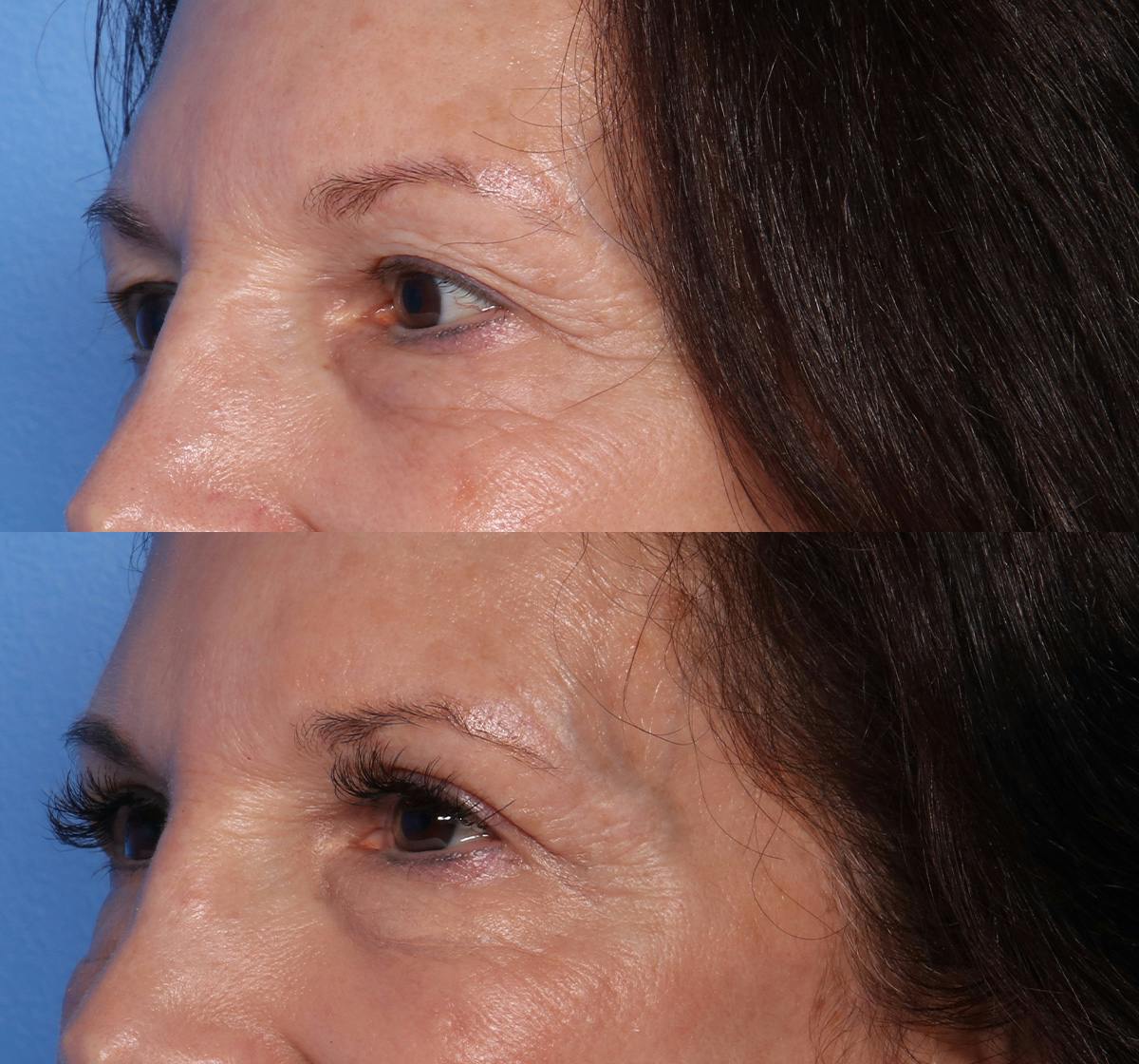 Blepharoplasty Before & After Gallery - Patient 203540 - Image 3