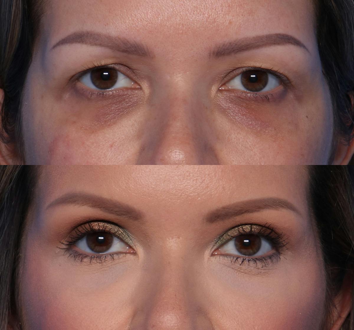 Blepharoplasty Before & After Gallery - Patient 311099 - Image 1