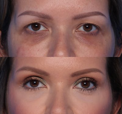 Blepharoplasty Before & After Gallery - Patient 311099 - Image 1