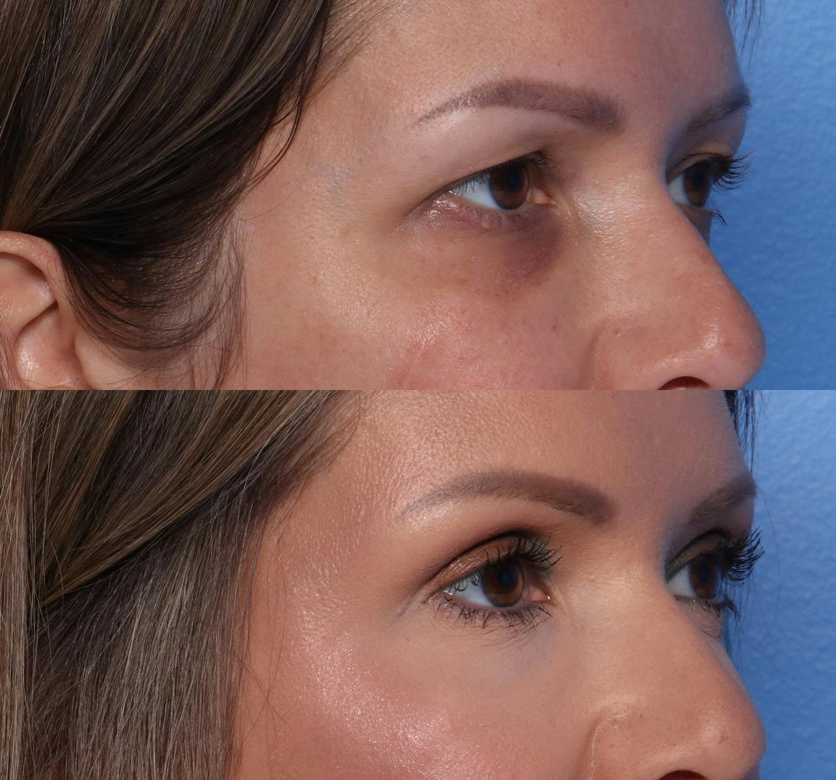 Blepharoplasty Before & After Gallery - Patient 311099 - Image 2
