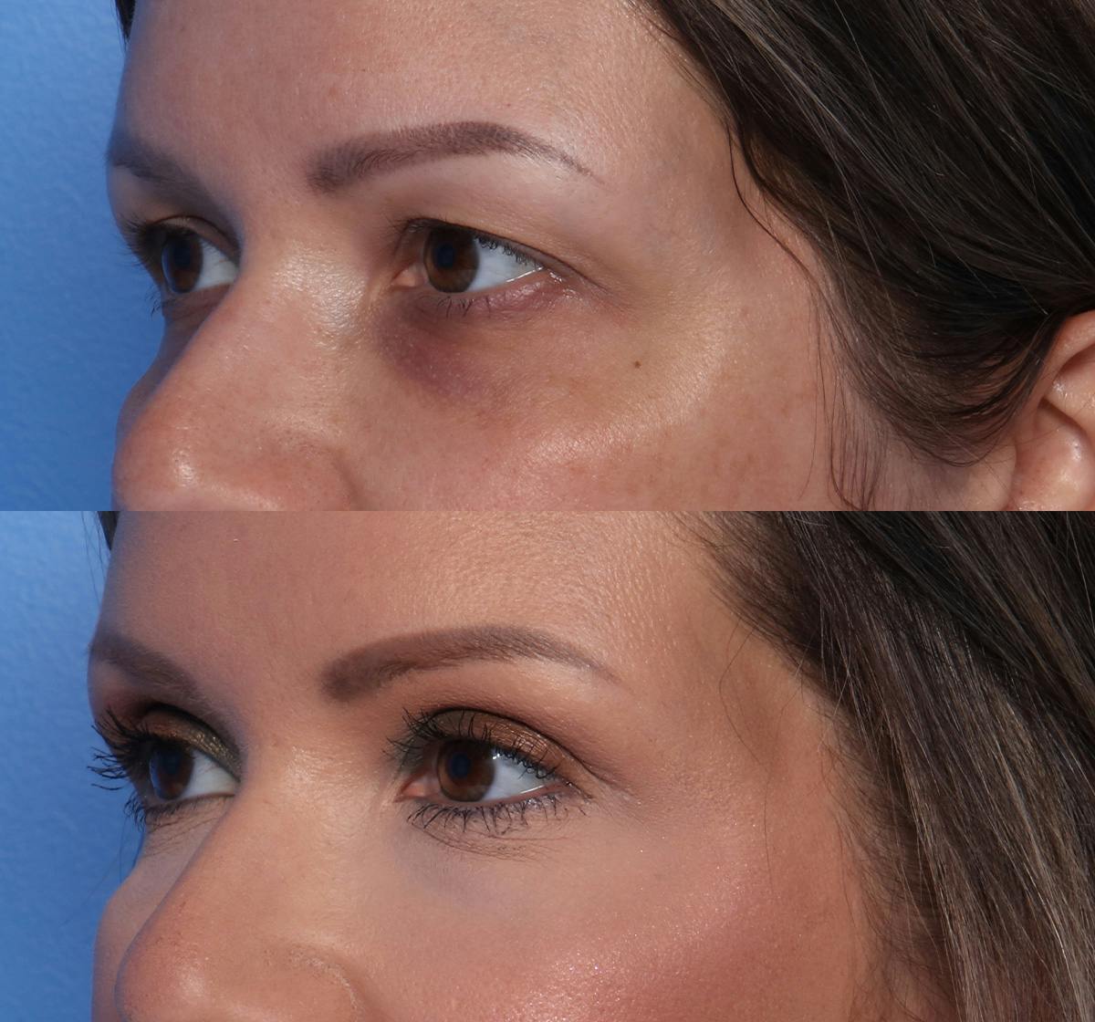 Blepharoplasty Before & After Gallery - Patient 311099 - Image 3