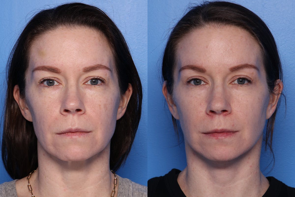 Neck Lift Before & After Gallery - Patient 418318 - Image 1
