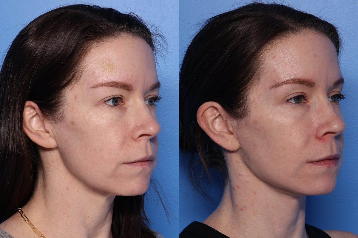 Neck Lift Before & After Gallery - Patient 418318 - Image 2