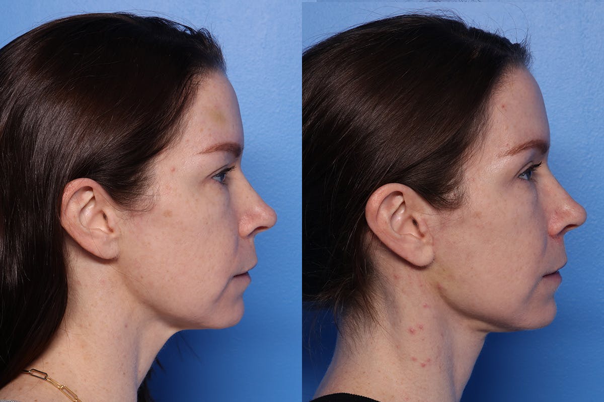 Neck Lift Before & After Gallery - Patient 418318 - Image 3