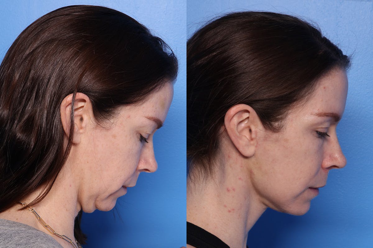 Neck Lift Before & After Gallery - Patient 418318 - Image 4